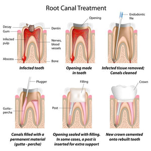 Probiotic Bacteria are Being Studied for Root Canals