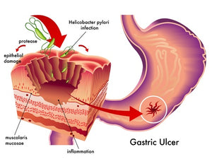 Could Probiotics Be the Answer for Helicobacter pylori (H. pylori) Infections?