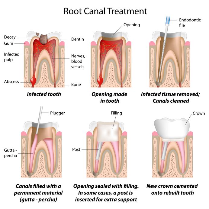 Probiotic Bacteria are Being Studied for Root Canals